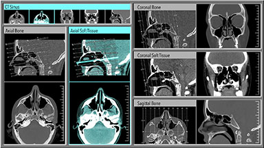 CAT Scan, Computed Tomography
